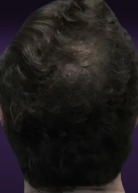 אחרי הטיפול, קודקוד של מטופל מאחור