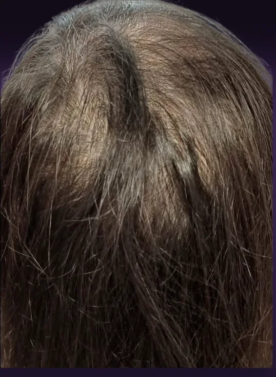 אחרי הטיפול, קודקוד מלמעלה